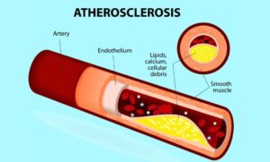 Atherosclerosis and Nutrition