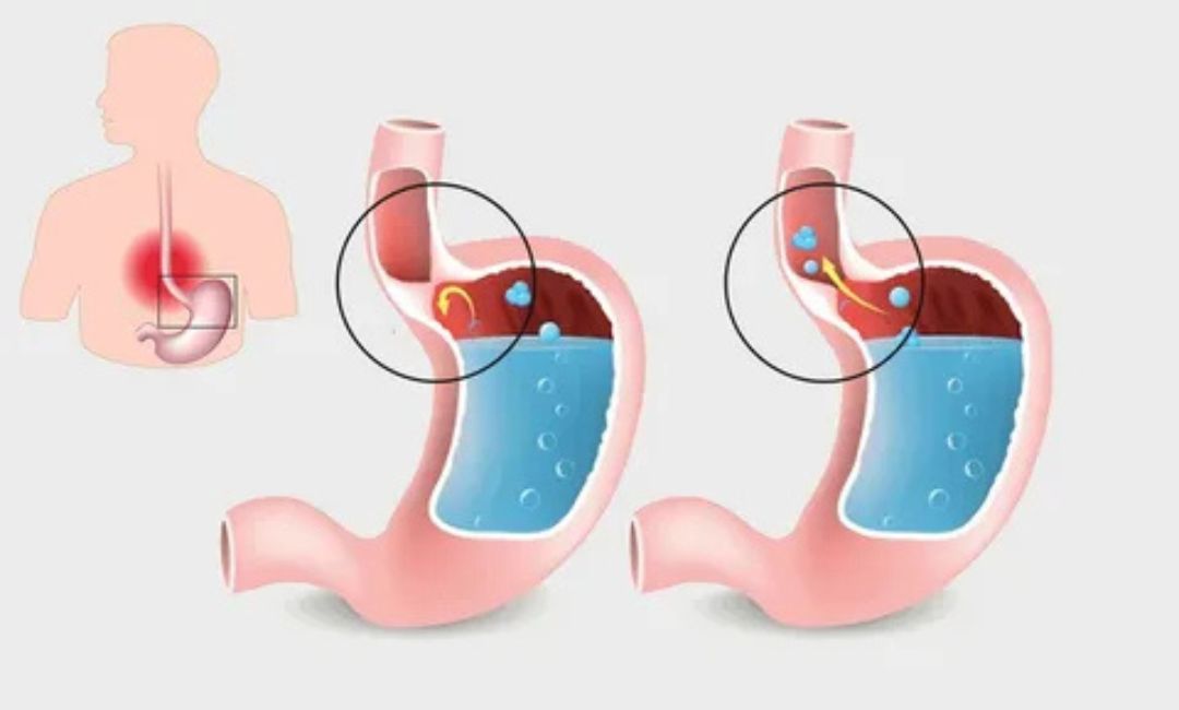 GERD: Gastroesophageal Reflux Disease