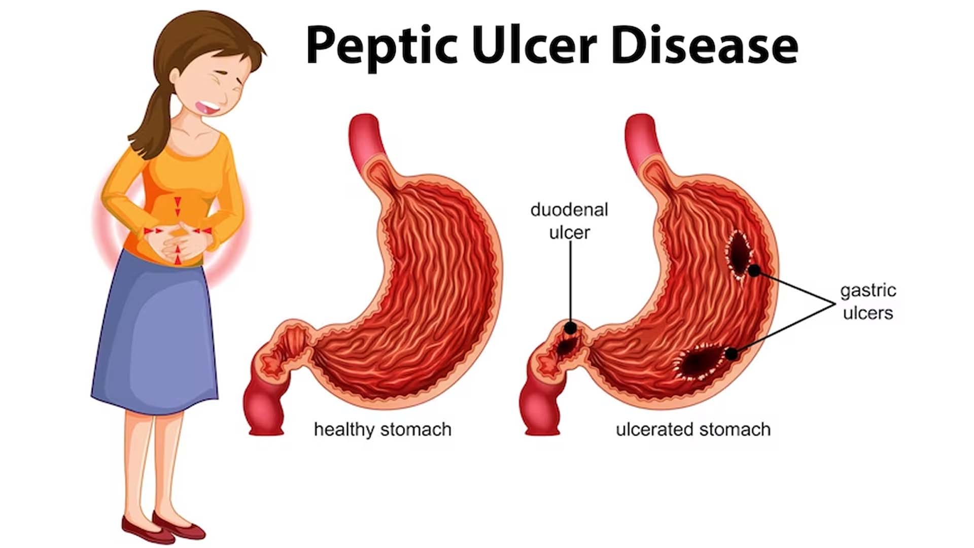 Peptic Ulcers: Symptoms, Diagnosis, and Nutritional Modification