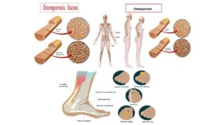 Understanding Osteoporosis