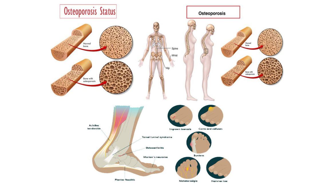 Understanding Osteoporosis: Causes, Symptoms, and Prevention